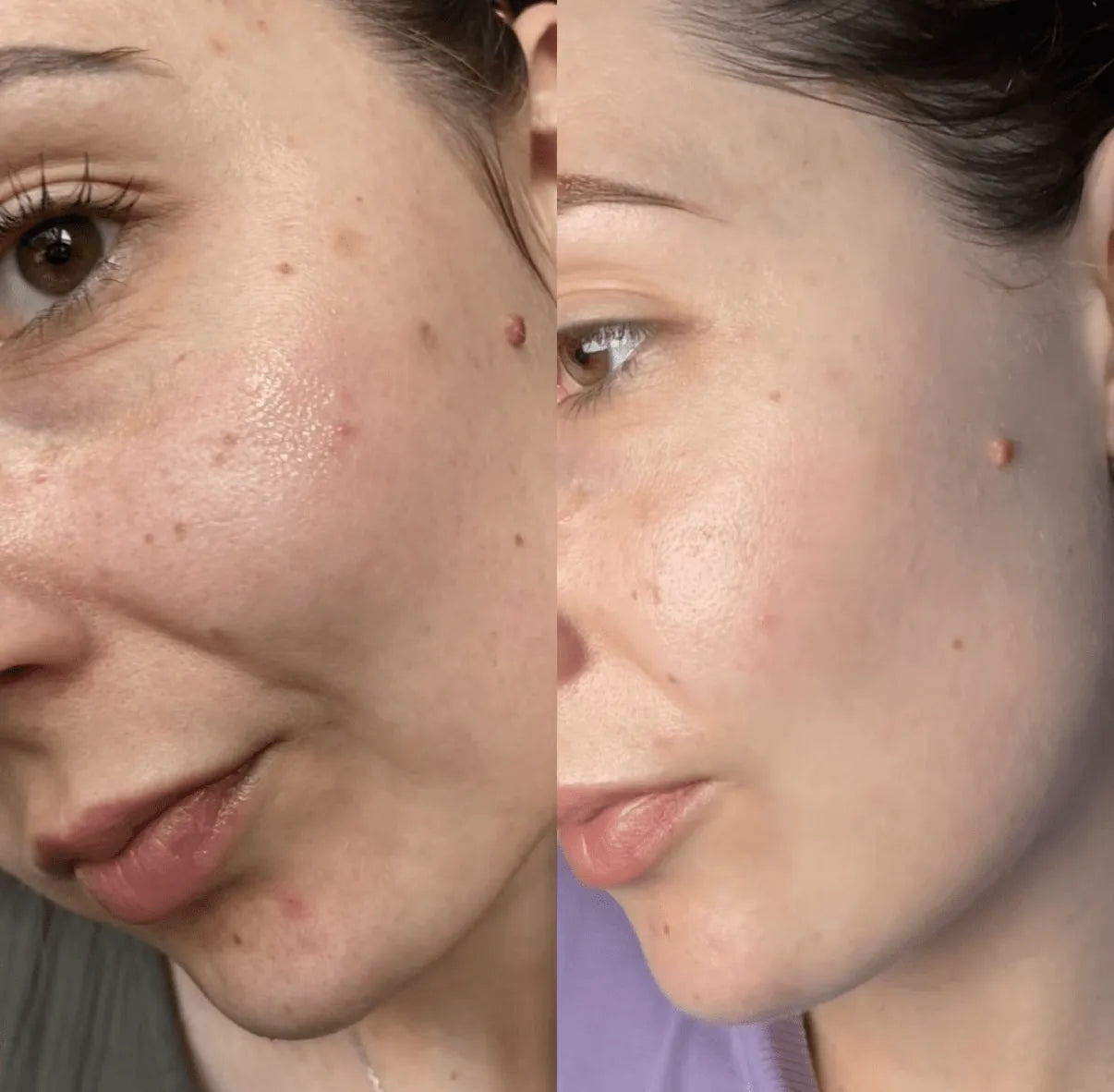 أنوا نياسيناميد 10% + TXA 4% مصل