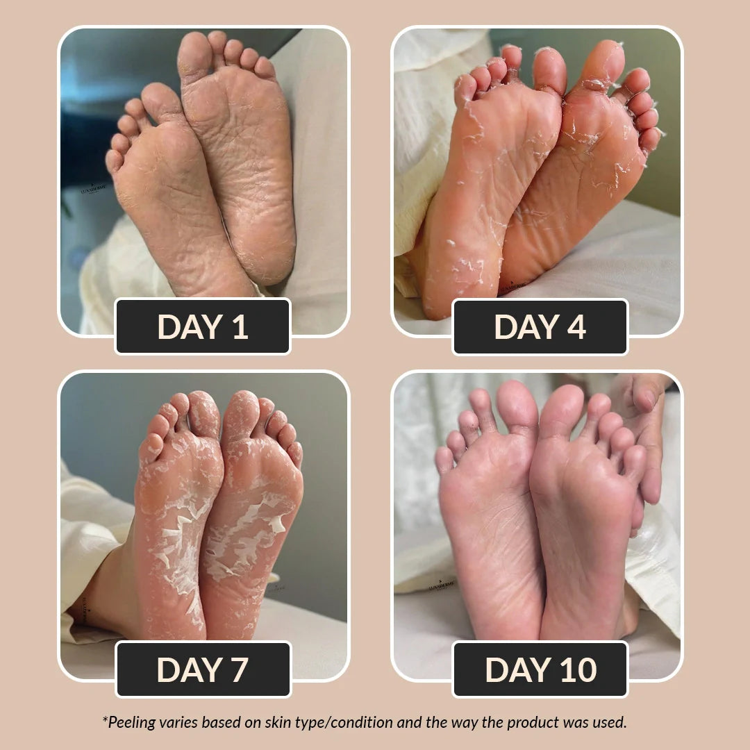 تقشير القدم باليا